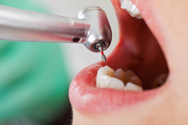 Best Emergency Root Canal Treatment in Aurora, IN